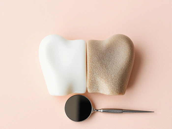 The difference between porcelain and composite veneers