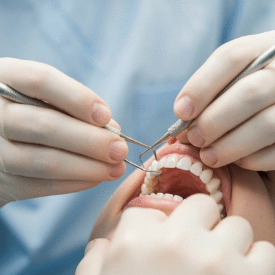 Close-up of a dentist applying porcelain veneer to a patient's tooth with precision tools.