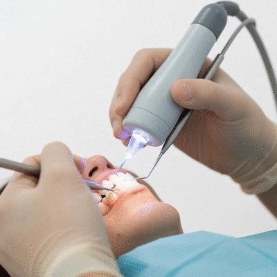 A close-up shot of a UV light being used by a dentist to cure composite resin on a patient's tooth, highlighting the hardening process, clean background, no text, no words, no typography, 8K